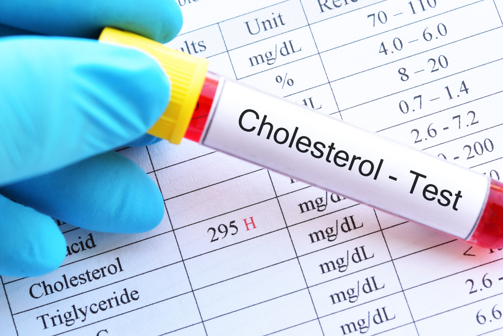 test tube labeled Cholesterol - Test over chart with high cholesterol results listed